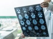 ASTUCE Spain sol·licita accés equitatiu a tractaments innovadors
