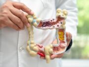 La prevenció i el cribratge, claus contra el càncer de còlon